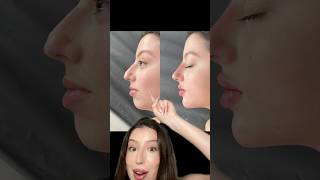 Filler before amp after filler lipfiller chinfiller nosefiller beforeandafter botox fillers [upl. by Sumahs615]