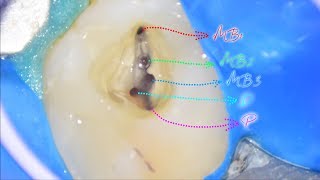 Extraordinary Root Canal Morphology in Upper Molar [upl. by Gombosi]