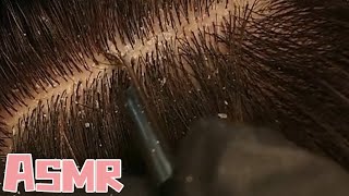 ASMR Super decompression scalp cleaning deep cleaning and gentle scraping little sister super [upl. by Eiznil914]