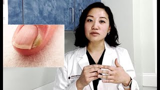 What is PARONYCHIA Its a nail infection  Solve Paronychia with Julia Ro PAC [upl. by Toffey289]