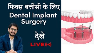 Dental Implant surgery for full mouth fix teeth  Fix Denture in Indore  DR Ankit Khasgiwala [upl. by Champ547]