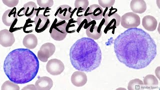 Acute Myeloid Leukemia AML w Monocytic Differentiation formerly AMML with Blasts amp Promonocytes [upl. by Fagan]