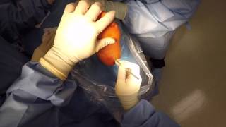 Plantar Fasciotomy [upl. by Anitsirhk]