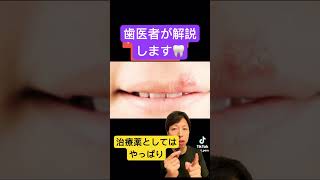 口内炎。何とかしたい🦷stomatitis 口内炎 応急処置 治療 早く治す 歯医者 薬 方法 歯科衛生士 歯科助手 豆知識 生理食塩水 [upl. by Neyrb]