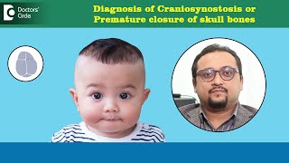 Early closure of head bones or joints in Babies Craniosynostosis DrVybhav Deraje Doctors Circle [upl. by Siednarb]