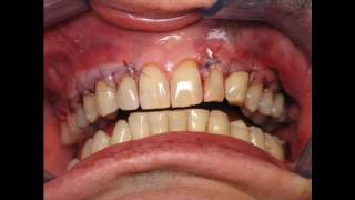 ★ Gingivitis Gel  Learn How I Cured My Gingivitus Permanently Without Surgery [upl. by Comstock]