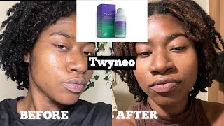 NEW Twyneo Tretinoin and Benzoyl Peroxide Review after 4 months Paulas Choice amp TruSkin for scars [upl. by Lerraj]