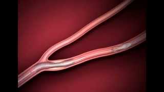 Dr AZENCOTT Stenose Carotide Angioplastie Stent Carotidien [upl. by Anom]