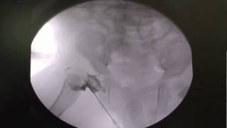 Arthrogram in older child with a successful hip joint reduction [upl. by Ephrayim]