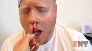 Nasal Packing Removal from The Nose Medical Videos [upl. by Arymas]