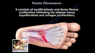 Plantar Fibromatosis  Everything You Need To Know  Dr Nabil Ebraheim [upl. by Skyla]