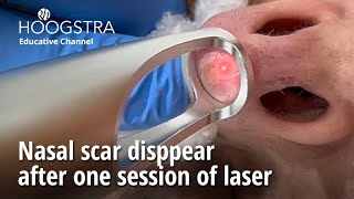 Nasal scar disppear after one session of laser  24144 [upl. by Adnohsat818]