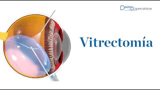 Vitrectomía  Doctores Especialistas [upl. by Notnek259]