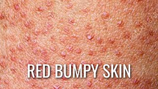 Keratosis Pilaris  How To Get Rid of Chicken Skin [upl. by Alletnahs]