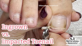 Pedicure Relief on Pincer INGROWN Toenail that Hurts [upl. by Celie497]