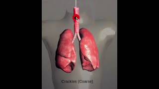 Lung SoundsNormal and AbnormalCracklesWheeze StridorRonchiOn Respiratory Auscultation Sound [upl. by Trabue247]