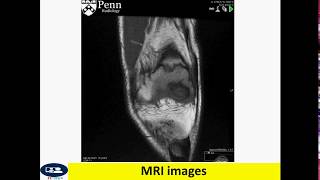 Juvenile osteochondritis dissecans [upl. by Christian]