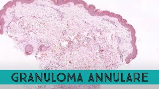 Granuloma annulare under the microscope mimic of ringworm tinea dermatophytosis pathology dermpath [upl. by Innattirb311]