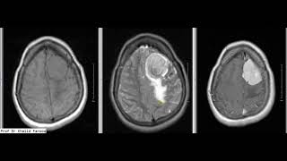 MENINGIOMA MRI BRAIN [upl. by Korney691]