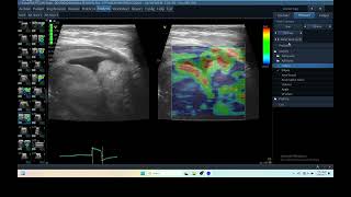 IQ 290 TFAST LUNG MASS ULTRASOUND ICP CPP ECHOPAC ANALYSIS ELASTOGRAPHY 3 [upl. by Dianemarie]