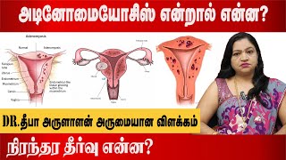 அடினோமையோசிஸ் என்றால் என்ன  adenomyosis treatment without surgery  Dr Deepa Arulaalan [upl. by Lohcin605]