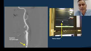 Karotis StentlemeŞah DamarıEsnasında Beyni Korumak için Kullanılan Yöntemlerden Biri Mo ma Cihazı [upl. by Fernandes]