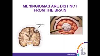 WEBINAR Treatment Strategies for Meningioma [upl. by Seligmann]