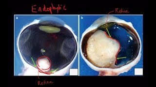 High Yield Topic Retinoblastoma  A Complete Review [upl. by Tnaryb]