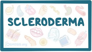 Scleroderma  an Osmosis Preview [upl. by Tiphanie]