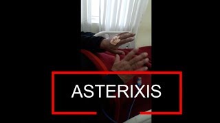 Asterixis  Flapping Tremor  Liver Flap [upl. by Suivatnod]