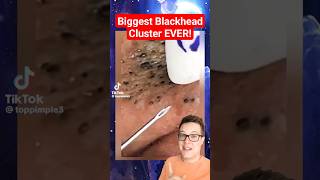 BIGGEST BLACKHEADS REMOVAL EVER  Extreme Blackheads on Cheek shorts [upl. by Hull375]