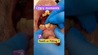 Crazy Teeth  Broken Fillings [upl. by Attej77]