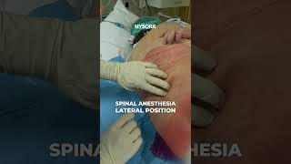 Spinal is best in sick patients anesthesia nerveblock [upl. by Romy929]