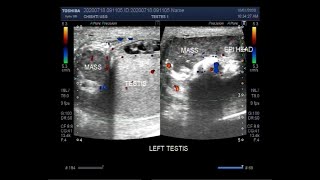 Ultrasound Video showing Epididymoorchitis Pyocele with septation Scrotal and Epididymal mass [upl. by Anier]