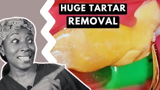 Massive TARTAR REMOVAL from teeth  TEETH CLEANING [upl. by Sev91]