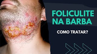 Como TRATAR FOLICULITE NA BARBA  SAIBA [upl. by Llebana]