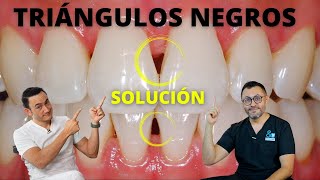 ¿Tienes huecostriángulos negros entre los dientes  Tratamiento y Causas [upl. by Leaw946]