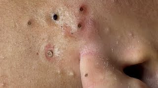 Big Cystic Acne Blackheads Extraction Blackheads amp Milia Whiteheads Removal Pimple Popping  1088 [upl. by Enotna63]