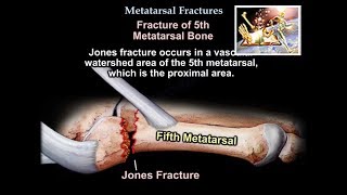 Metatarsal Fractures  Everything You Need To Know  Dr Nabil Ebraheim [upl. by Ear]