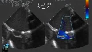 Insuffisances Mitrales Congénitales  Vidéo 2 [upl. by Yenolem596]