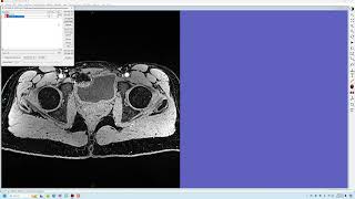 MRI Hip Atlas construction [upl. by Oznola]