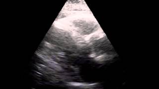 Parasternal long axis Normal contractile functionatrial fibrillation By dr Chatziathanasiou [upl. by Humfrid]