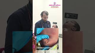 Umbilical Granuloma information अम्बिलिकल ग्रॅन्युलोमा माहीती [upl. by Pantin]