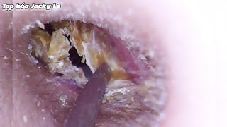 Ear Wax Removal 199 The earwax was so big that it made him itchy and painful  Ear Cleaning ASMR [upl. by Odnalref]