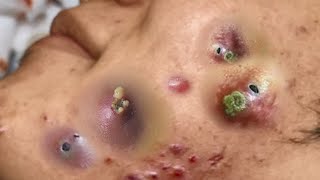 Big Cystic Acne Blackheads Extraction Blackheads amp Milia Whiteheads Removal Pimple Popping 047 [upl. by Abraham]