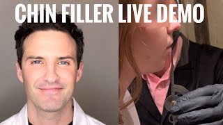 Chin Fillers Live Demo with Explanation [upl. by Ahsratal]