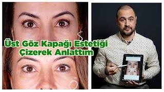 Üst Göz Kapağı Estetiği Sonuç  Uygulamalı Anlattım [upl. by Toomay]