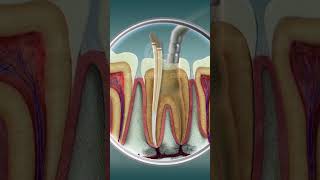 Root Canal Treatment  Curveia Dental I RCT [upl. by Nashom333]