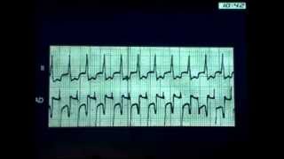 Arritmias Supraventriculares e ventriculares DR [upl. by Sandeep]