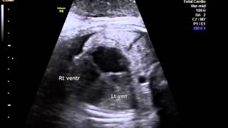 Dilated cardiomyopathy with associated MR and TR in fetus [upl. by Deer]